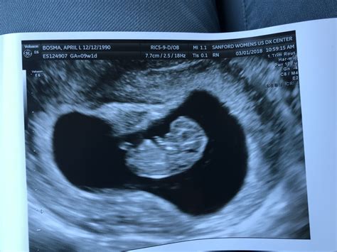 dating ultrasound at 7.5 weeks
